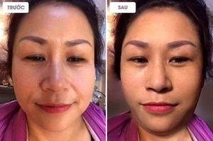 hình ảnh thực tế khách hàng sau khi sử dụng viên tru face